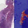 google-ai-kanser-teshisinde-insanlardan-basarili