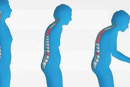 Türkiye’de “osteoporoz salgını” bekleniyor: 50 yaş üzeri 3 kadından ve 5 erkekten 1’inde kırığa neden oluyor