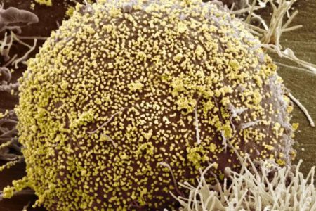 İlk defa bir kadının, yeni bir metot ile HIV’i yendiğine inanılıyor