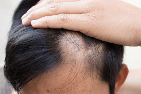 FDA Onaylı İlk Saç Dökülmesi İlacı, Hastaların Yarısında Saç Çıkmasını Sağlıyor