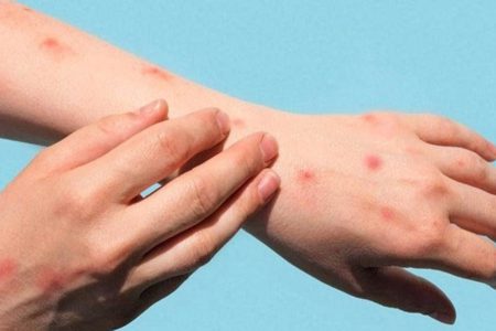 Maymun çiçeği virüsü 92 ülkede görüldü: Dünya genelindeki vaka sayısı 35 bini aştı