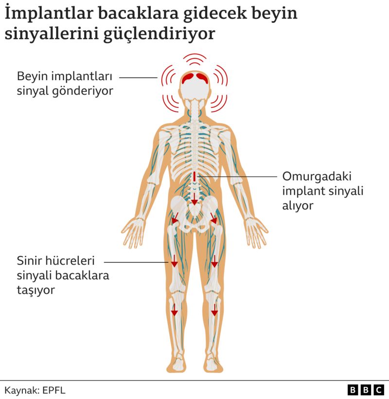 implant-beyin